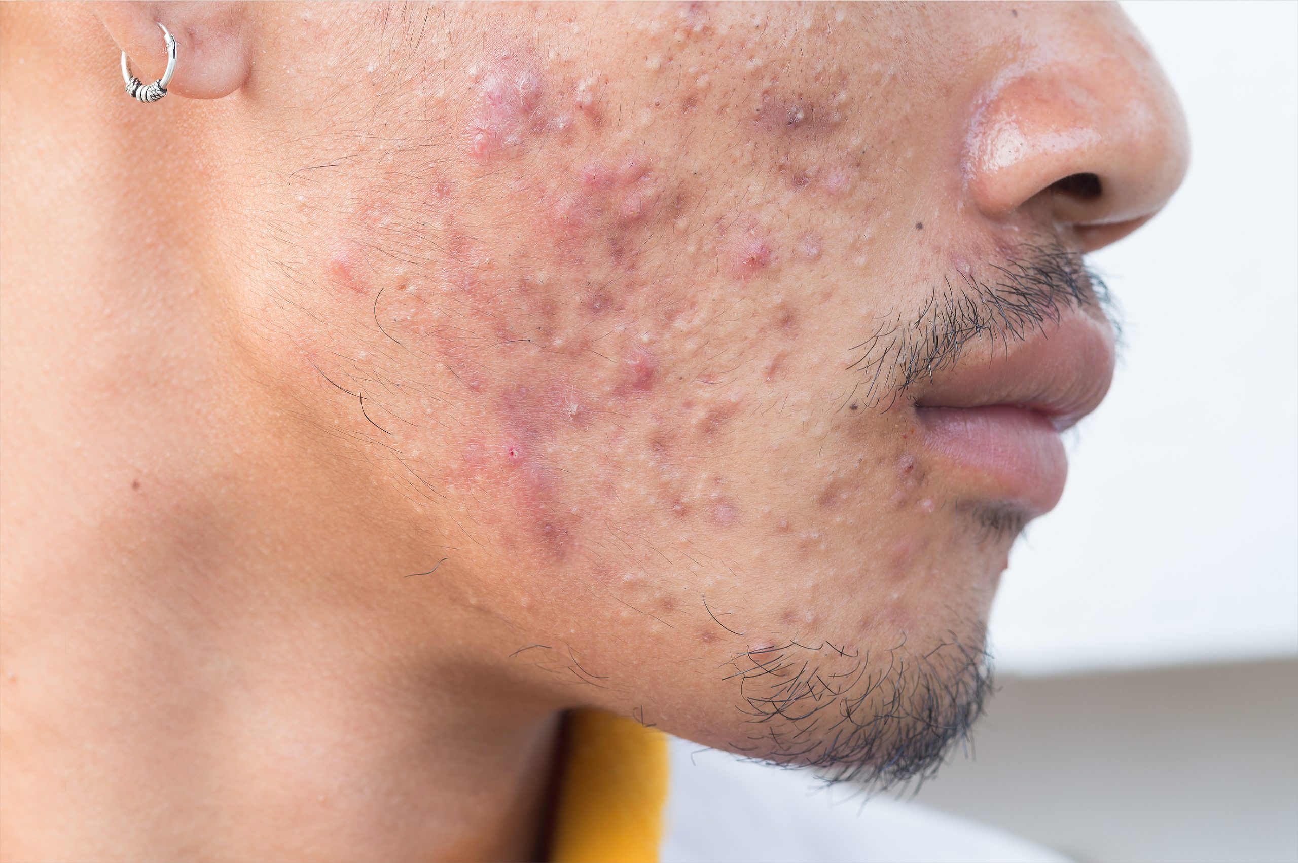 Man face with acne and pimples